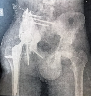 Xray of Trent's hip